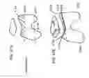 Fig. 65 - Patient-adapted and improved articular implants, designs and related guide tools