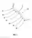 Fig. 02 - Prosthetic knee joint