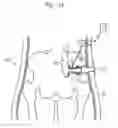Fig. 100 - Apparatus for controlling flow in a bodily organ