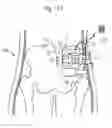 Fig. 101 - Apparatus for controlling flow in a bodily organ