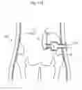 Fig. 115 - Apparatus for controlling flow in a bodily organ