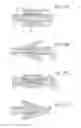 Fig. 148 - Apparatus for controlling flow in a bodily organ