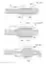 Fig. 152 - Apparatus for controlling flow in a bodily organ