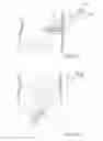Fig. 17 - Apparatus for controlling flow in a bodily organ