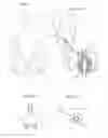 Fig. 52 - Apparatus for controlling flow in a bodily organ