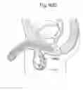 Fig. 60 - Apparatus for controlling flow in a bodily organ