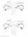 Fig. 65 - Apparatus for controlling flow in a bodily organ