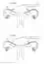 Fig. 67 - Apparatus for controlling flow in a bodily organ