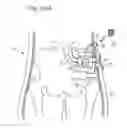 Fig. 84 - Apparatus for controlling flow in a bodily organ