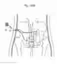 Fig. 85 - Apparatus for controlling flow in a bodily organ