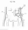 Fig. 96 - Apparatus for controlling flow in a bodily organ
