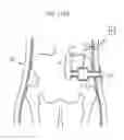 Fig. 97 - Apparatus for controlling flow in a bodily organ