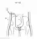 Fig. 98 - Apparatus for controlling flow in a bodily organ