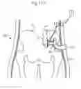 Fig. 99 - Apparatus for controlling flow in a bodily organ