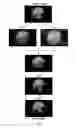 Fig. 04 -  AUTOMATIC OPACITY DETECTION SYSTEM FOR CORTICAL CATARACT DIAGNOSIS