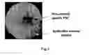 Fig. 05 -  AUTOMATIC OPACITY DETECTION SYSTEM FOR CORTICAL CATARACT DIAGNOSIS
