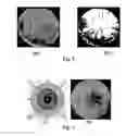 Fig. 08 -  AUTOMATIC OPACITY DETECTION SYSTEM FOR CORTICAL CATARACT DIAGNOSIS