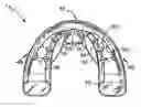 Fig. 01 - Orthodontic appliance