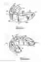 Fig. 02 - Orthodontic appliance