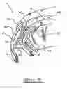 Fig. 06 - Orthodontic appliance