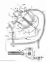 Fig. 02 - Miniature circular mapping catheter