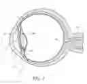 Fig. 02 - Ocular implant delivery systems