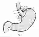 Fig. 02 - Bariatric device and method