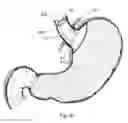 Fig. 07 - Bariatric device and method