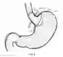 Fig. 09 - Bariatric device and method
