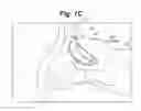 Fig. 03 - Devices and methods for minimally invasive access to sinuses and treatment of sinusitis