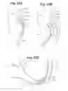 Fig. 22 - Devices and methods for minimally invasive access to sinuses and treatment of sinusitis