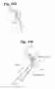 Fig. 35 - Devices and methods for minimally invasive access to sinuses and treatment of sinusitis