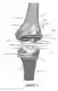 Fig. 02 - Low profile patient specific cutting blocks for a knee joint