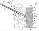 Fig. 01 - Method and composition for use in reinforcing bone