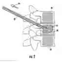 Fig. 04 - Method and composition for use in reinforcing bone