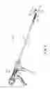 Fig. 11 - FINGER GUIDED SUTURE FIXATION SYSTEM