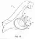Fig. 14 - FINGER GUIDED SUTURE FIXATION SYSTEM