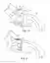 Fig. 15 - FINGER GUIDED SUTURE FIXATION SYSTEM