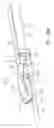 Fig. 76 - Centering of delivery devices with respect to a septal defect