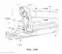 Fig. 82 - Centering of delivery devices with respect to a septal defect