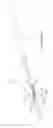 Fig. 89 - Centering of delivery devices with respect to a septal defect