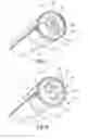 Fig. 05 - OTOMY CLOSURE DEVICE