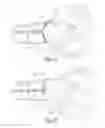 Fig. 10 - OTOMY CLOSURE DEVICE