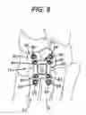Fig. 06 - Method and plate for fusing the medial column bones of the foot