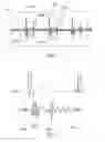 Fig. 02 - Active implantable medical device for cardiac resynchronization with automatic optimization of atrioventricular and interventricular delays