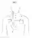 Fig. 04 - Nerve stimulation device