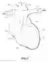 Fig. 02 - Cardiac resynchronization system employing mechanical measurement of cardiac walls