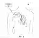 Fig. 03 - Implantable medical device with selectively configurable exposure operating mode programming options