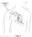 Fig. 03 - Implantable medical device with selectively configurable exposure operating mode programming options