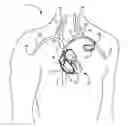 Fig. 01 - MRI compatible tachycardia lead
